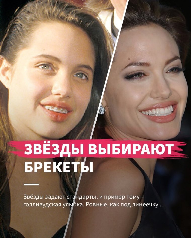 Анджелина Джоли брекеты